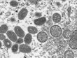 Informations sur le premier cas de variole du singe au Vietnam