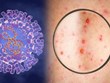 Un nouveau cas de variole du singe enregistré à Ho Chi Minh-Ville