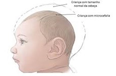 Zika : une bébé aurait été atteinte de microcéphalie Vietnam