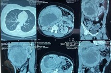 Intervention chirurgicale réussie sur une tumeur pancréatique "géante"