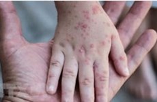 La Thaïlande confirme le premier cas féminin de monkeypox