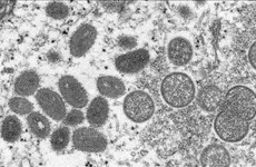 Informations sur le premier cas de variole du singe au Vietnam
