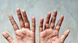 Le ministère indonésien de la Santé rassure les habitants sur la variole du singe