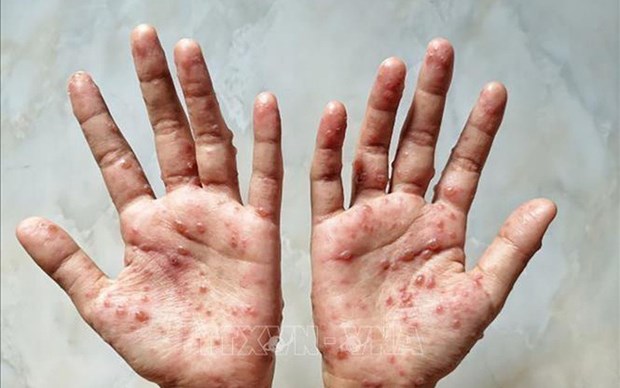 Le ministere de la Sante recommande des mesures preventives contre la variole du singe hinh anh 1