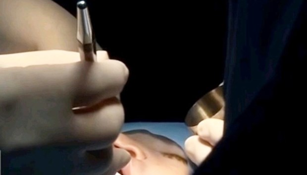 Treize chirurgiens japonais au chevet des nouveau-nes atteints de bec-de-lievre hinh anh 1