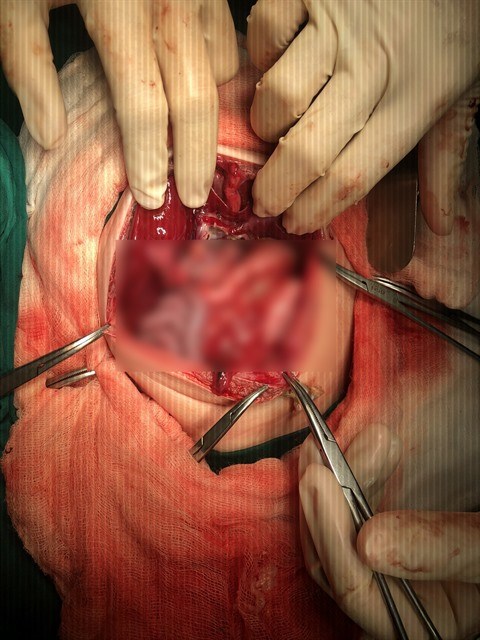 Intervention chirurgicale satisfaisante sur un fœtus in fœtu a l’hopital pediatrique Nhi dong 2 hinh anh 1
