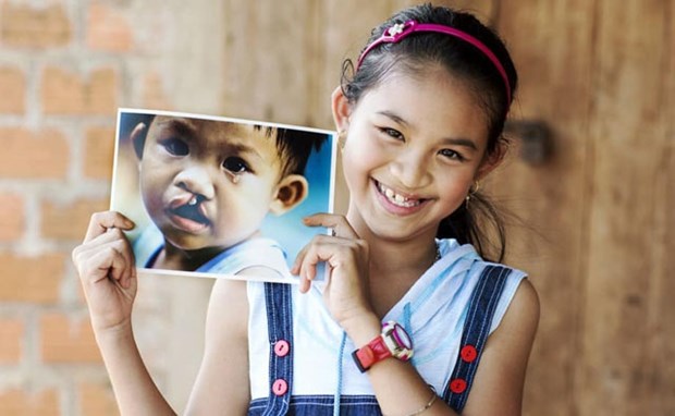 Operation Smile Vietnam rendra le sourire a 200 enfants en mars hinh anh 1